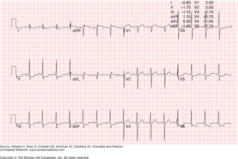 resting electrocardiographic results|Chapter 108: The Resting Electrocardiogram .